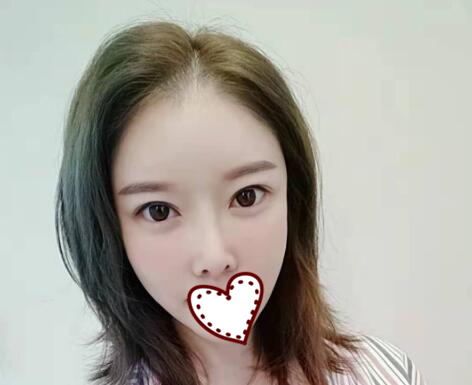 北京亞奇龍醫(yī)療美容診所整形醫(yī)生陳煥然雙眼皮案例