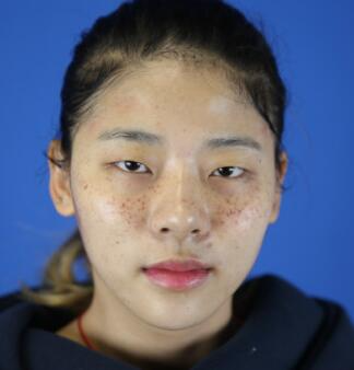 福州愛思特比華利整形林秋榮激光祛斑效果太贊了，終于沒人叫我“斑花”了