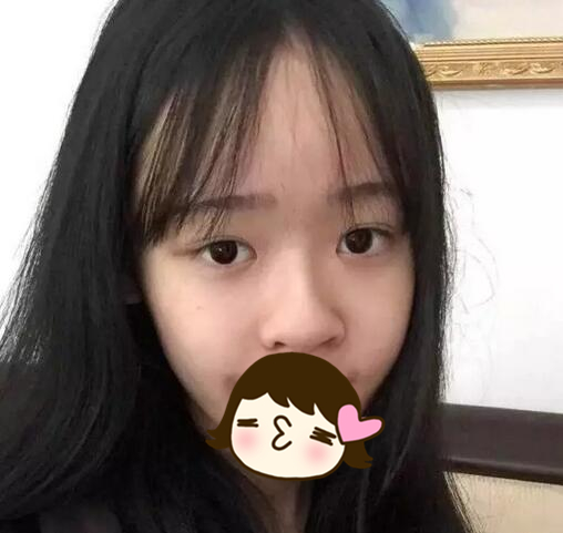 廈門海峽整形美容醫(yī)院醫(yī)生張宏隆鼻案例，效果很棒