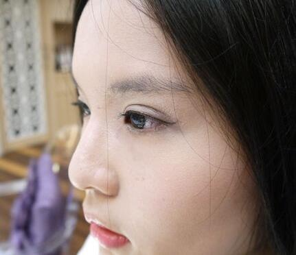 青島大學(xué)醫(yī)學(xué)院整形美容科陳振宇醫(yī)生做雙眼皮怎么樣？案例效果太驚艷