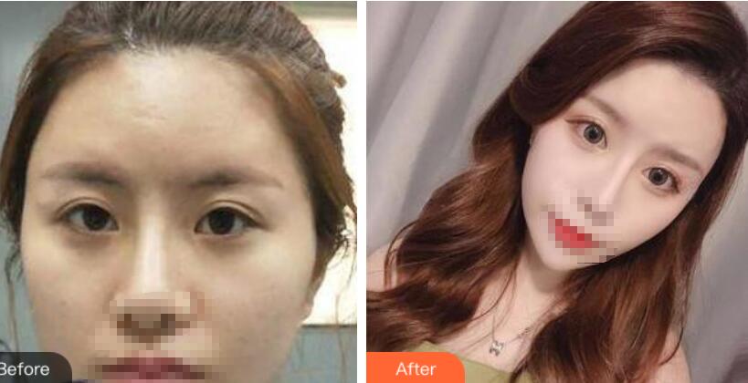 鄭州風(fēng)信子整形醫(yī)院雙眼皮案例效果圖對(duì)比