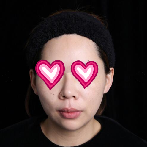 西安儷人醫(yī)院整形醫(yī)生蘇鵬做隆鼻技術(shù)怎么樣？附蘇鵬醫(yī)生隆鼻案例