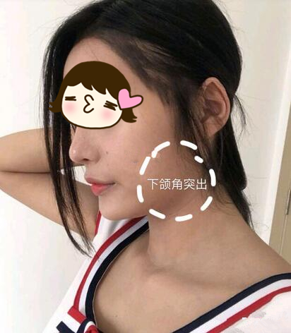 滄州瑞美醫(yī)療整形專家張鵬做下頜角磨骨整形技術(shù)怎么樣？附案例