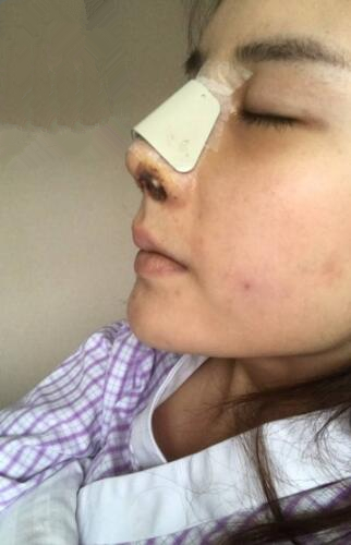 手術(shù)結(jié)束后