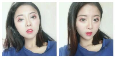 深圳嶺南醫(yī)院整形醫(yī)生丁祖鑫做假體豐太陽穴案例效果對(duì)比圖