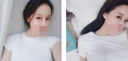 寧波美仁整形美容醫(yī)院李英大醫(yī)生做切開雙眼皮效果怎么樣？