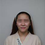 深圳尚虹醫(yī)療整形醫(yī)生藍劍雄做自體脂肪豐面頰效果怎么樣？附案例