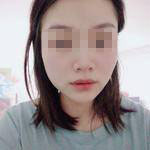 濟南曹博士美容整形醫(yī)院做玻尿酸豐面頰怎么樣？陳正喜醫(yī)生案例