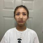 濟(jì)南鵬愛(ài)整形醫(yī)生楊力做顴骨顴弓整形技術(shù)怎么樣？楊力醫(yī)生案例展示