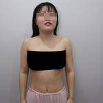 南寧伊美整形醫(yī)生凌宏量做自體脂肪隆胸怎么樣？自體脂肪隆胸案例