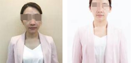 上海攸維醫(yī)療美容診所整形醫(yī)生李靜做膨體隆鼻案例展示