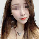 深圳尚虹醫(yī)療整形醫(yī)生藍劍雄做自體脂肪豐面頰效果怎么樣？附案例