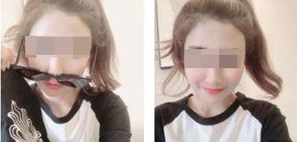 術(shù)后照片 術(shù)后照片