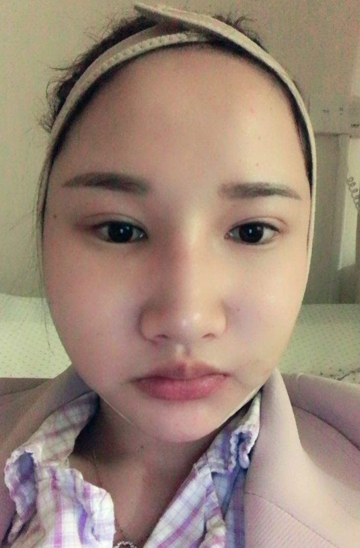 廣州廣大整形醫(yī)生秦瑜做顴骨內(nèi)推+下頜角整形怎么樣？附案例