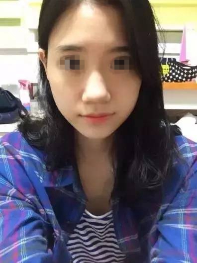 金奇龍膨體隆鼻案例展示