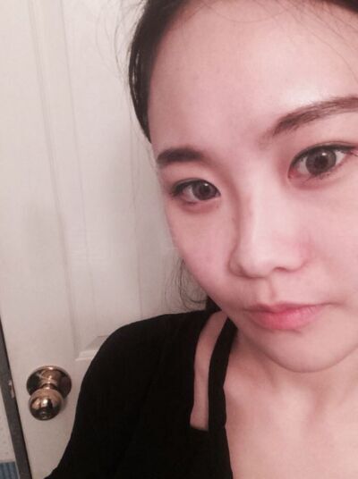 貴陽(yáng)長(zhǎng)江醫(yī)院整形美容中心韓盛斌醫(yī)生做自體脂肪隆鼻+全臉填充案例