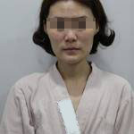 做完自體脂肪豐面頰后，我的面部比例更加完美了呢