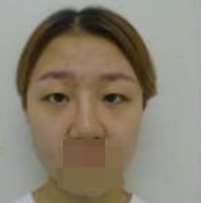 做了全切雙眼皮不僅外表變美了，內(nèi)心也更加自信了