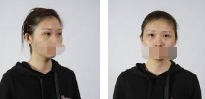 沒有了眼袋困擾，身體和心態(tài)都年輕了十歲