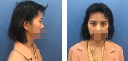 做了切開雙眼皮手術，才發(fā)現(xiàn)自己原來可以這么美！