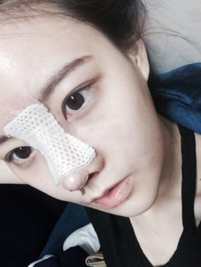 貴陽(yáng)長(zhǎng)江醫(yī)院整形美容中心韓盛斌醫(yī)生做自體脂肪隆鼻+全臉填充案例