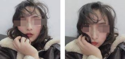 自體軟骨隆鼻案例