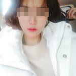 做完自體脂肪豐面頰后，我的面部比例更加完美了呢