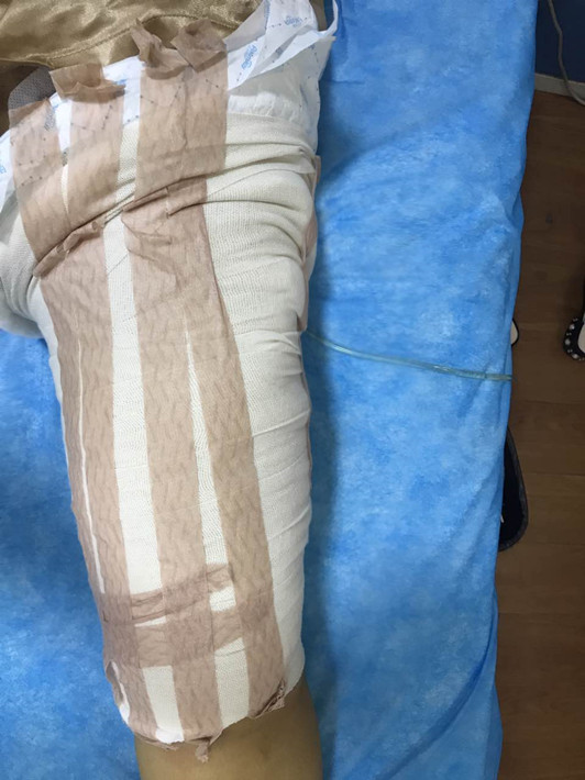 廣州軍頤醫(yī)院整形美容中心石建薇醫(yī)生腰腹吸脂真實案例對比圖