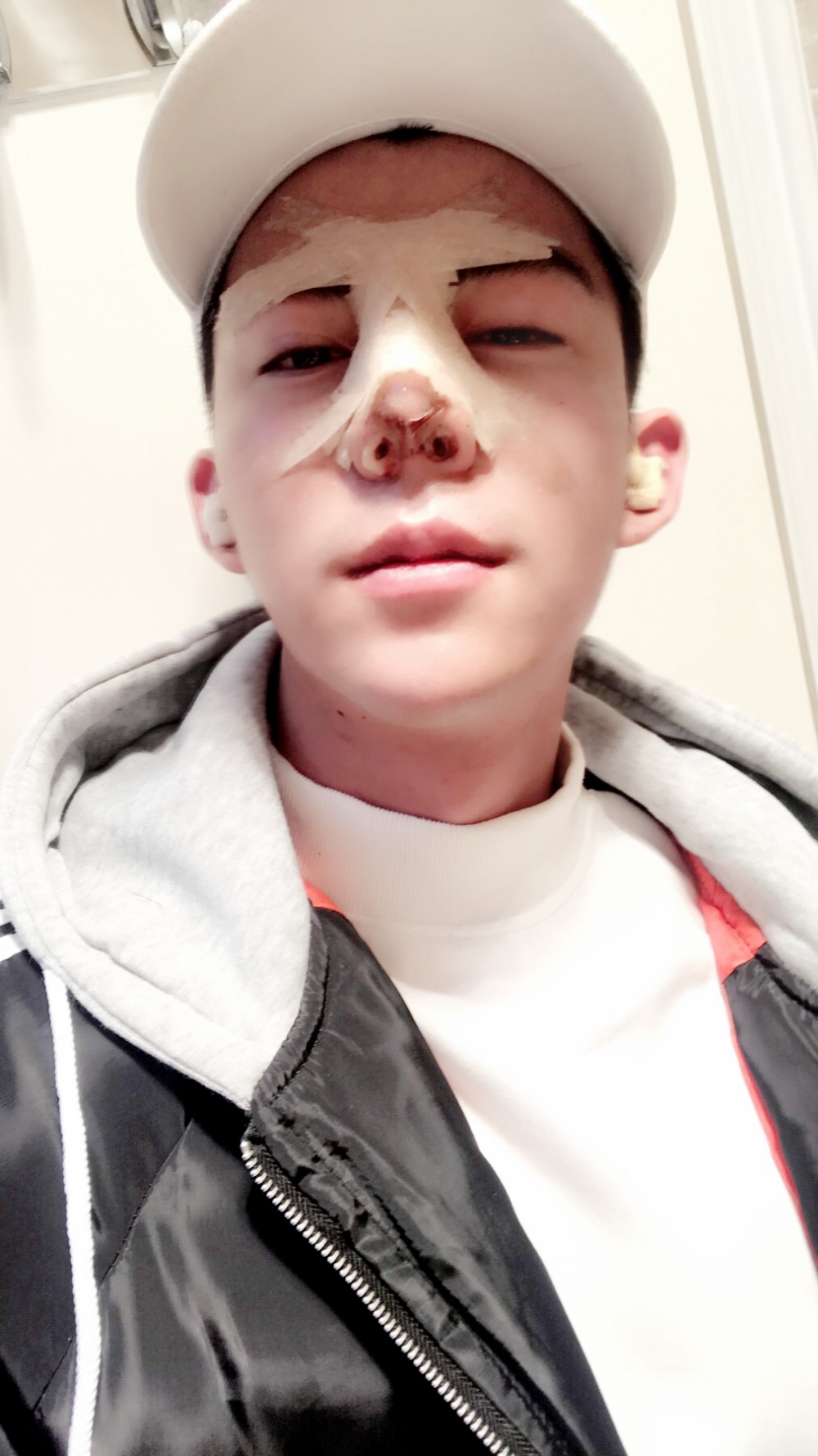 濟寧名美醫(yī)療整形醫(yī)生李唯少假體隆鼻+耳軟骨墊鼻尖真實案例效果對比圖 濟寧名美醫(yī)療整形醫(yī)生李唯少假體隆鼻+耳軟骨墊鼻尖真實案例效果對比圖