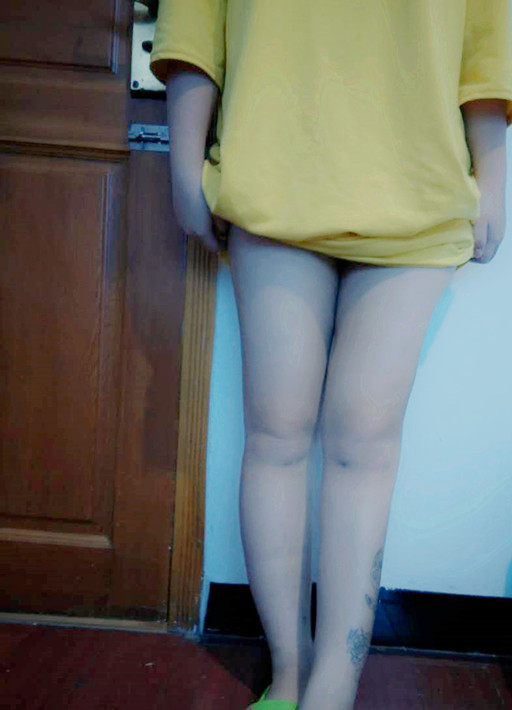 廣州軍頤醫(yī)院整形美容中心石建薇醫(yī)生腰腹吸脂真實案例對比圖