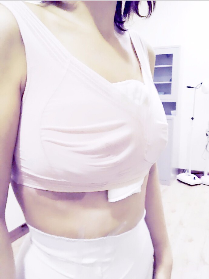 馬戰(zhàn)勝自體脂肪隆胸案例效果對(duì)比圖