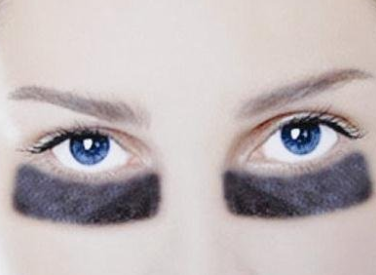 長(zhǎng)沙松禾醫(yī)療美容診所激光去黑眼圈