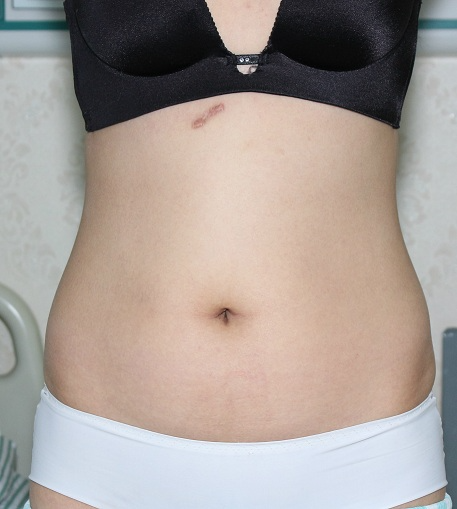 深圳晨曦整形醫(yī)院吉米斯做腰腹吸脂怎么樣？附吉米斯醫(yī)生腰腹吸脂案例