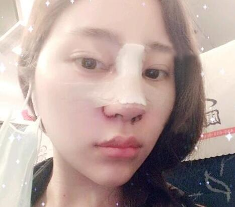 蘇州明基醫(yī)院醫(yī)療美容科做鼻綜合整形怎么樣？蘇州明基鼻綜合整形案例