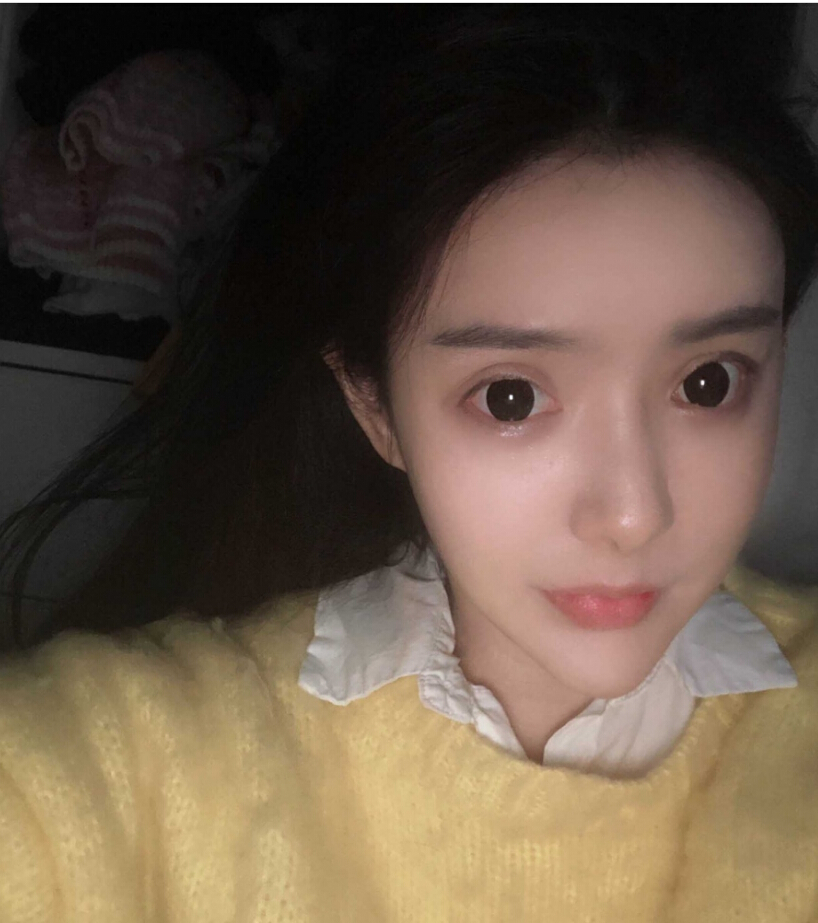 重慶柏漫醫(yī)療美容診所高紅艷醫(yī)生做面部吸脂怎么樣？面部吸脂案例分享