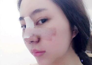 蘇州明基醫(yī)院醫(yī)療美容科做鼻綜合整形怎么樣？蘇州明基鼻綜合整形案例