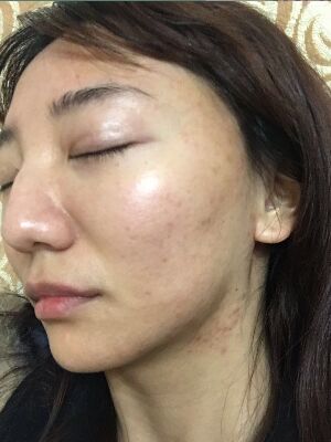 重慶柏漫醫(yī)療美容診所做激光祛痘效果怎么樣？白亞亞激光祛痘案例