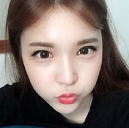 象山華美整形美容醫(yī)院趙誠(chéng)厚醫(yī)生做切開雙眼皮+開內(nèi)眼角整形案例