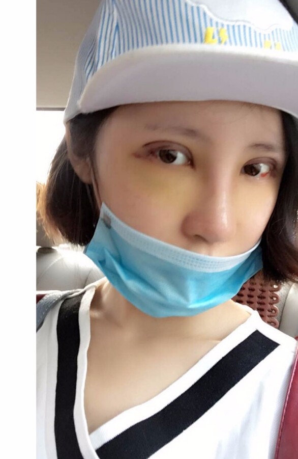 長(zhǎng)沙愛(ài)思特整形醫(yī)院陳星光醫(yī)生做鼻部多項(xiàng)+自體脂肪隆鼻+切開(kāi)雙眼皮+開(kāi)外眼角案例