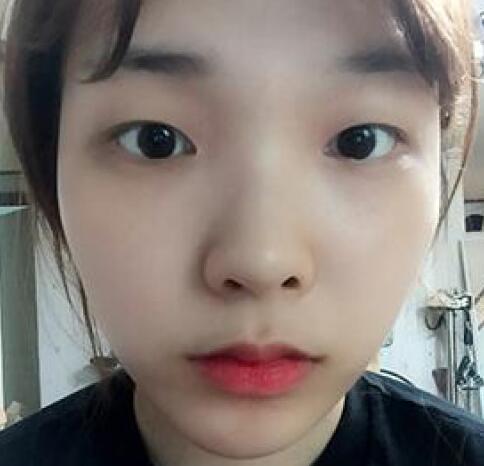 象山華美整形美容醫(yī)院趙誠厚醫(yī)生做切開雙眼皮+開內(nèi)眼角整形案例