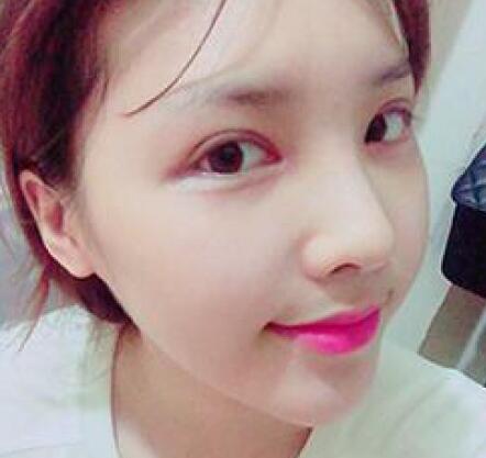 象山華美整形美容醫(yī)院趙誠厚醫(yī)生做切開雙眼皮+開內(nèi)眼角整形案例