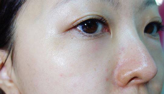 徐州時光洪揚醫(yī)療美容診所宮昔愿醫(yī)生做激光祛斑效果怎么樣？