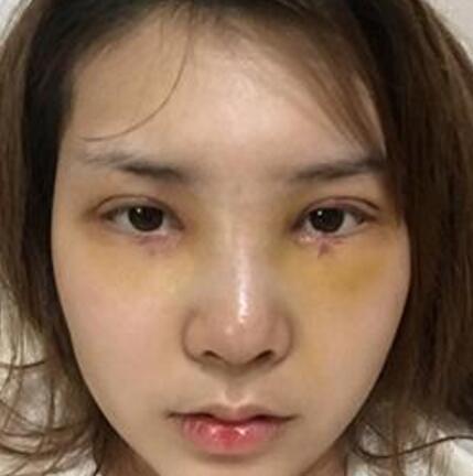 象山華美整形美容醫(yī)院趙誠厚醫(yī)生做切開雙眼皮+開內(nèi)眼角整形案例