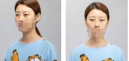 太原歐美蓮整形醫(yī)院丁曉峰醫(yī)生做雙眼皮怎么樣？丁曉峰雙眼皮手術(shù)案例分享