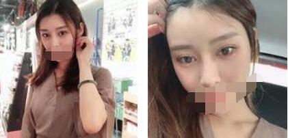 太原歐美蓮整形醫(yī)院丁曉峰醫(yī)生做雙眼皮怎么樣？丁曉峰雙眼皮手術(shù)案例分享