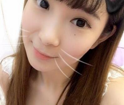 武漢中翰整形外科醫(yī)院陳志鵬醫(yī)生做雙眼皮修復效果怎么樣？附雙眼皮修復案例