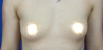 慈溪悅爾整形醫(yī)院趙天宇做自體脂肪隆胸怎么樣？附自體脂肪隆胸案例