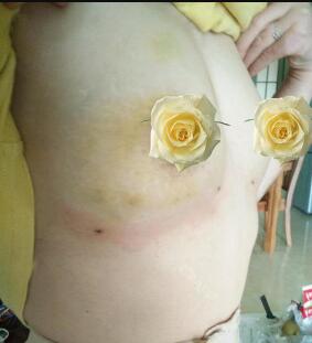 慈溪悅爾整形醫(yī)院趙天宇做自體脂肪隆胸怎么樣？附自體脂肪隆胸案例