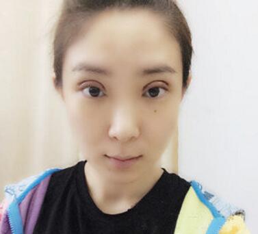 武漢中翰整形外科醫(yī)院陳志鵬醫(yī)生做雙眼皮修復效果怎么樣？附雙眼皮修復案例