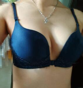 慈溪悅爾整形醫(yī)院趙天宇做自體脂肪隆胸怎么樣？附自體脂肪隆胸案例